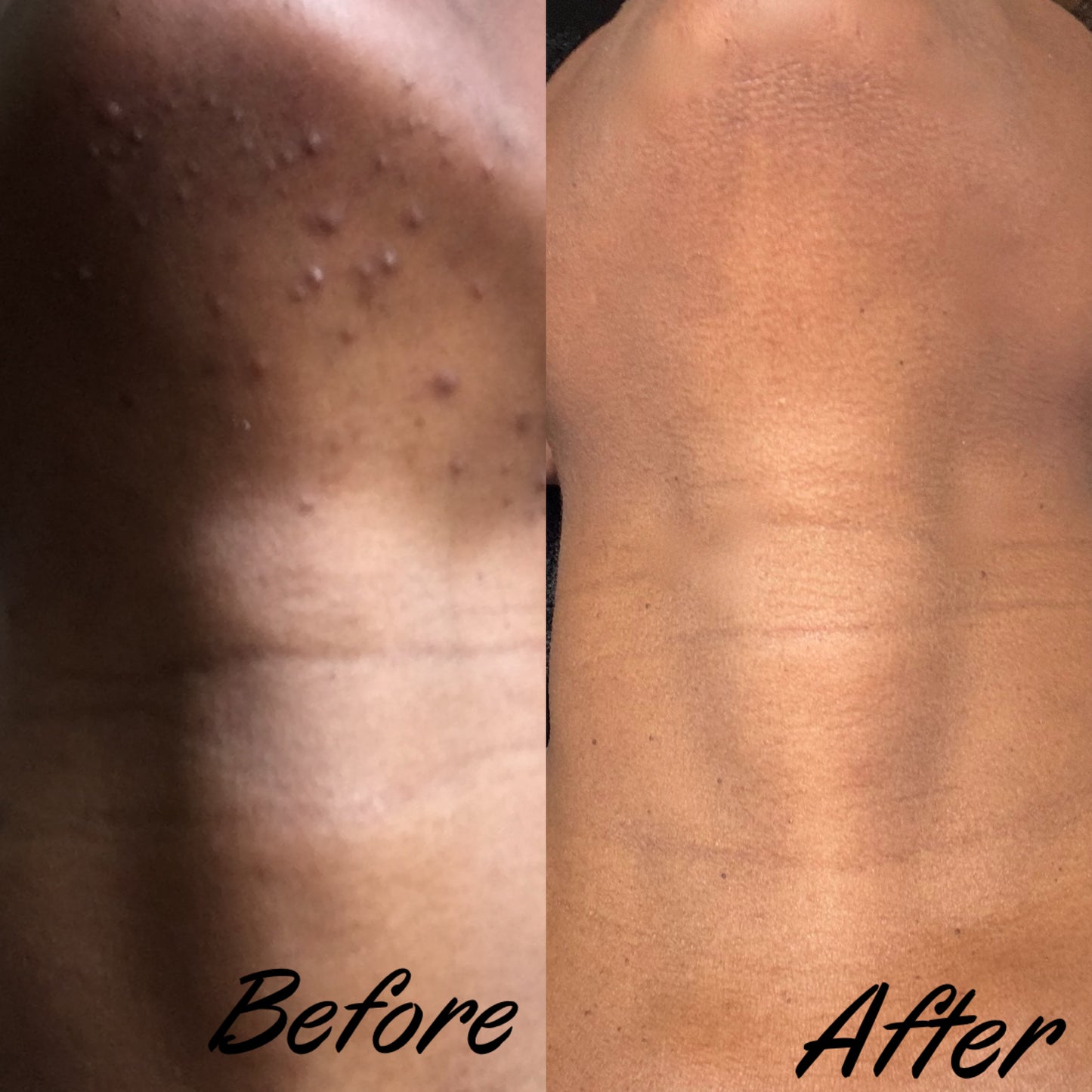 Acne Skincare Bundle